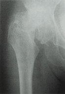 変形性股関節症 末期股関節症のレントゲン写真