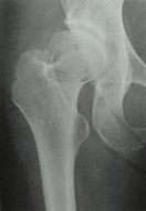 変形性股関節症 前股関節症＝臼蓋形成不全のレントゲン写真